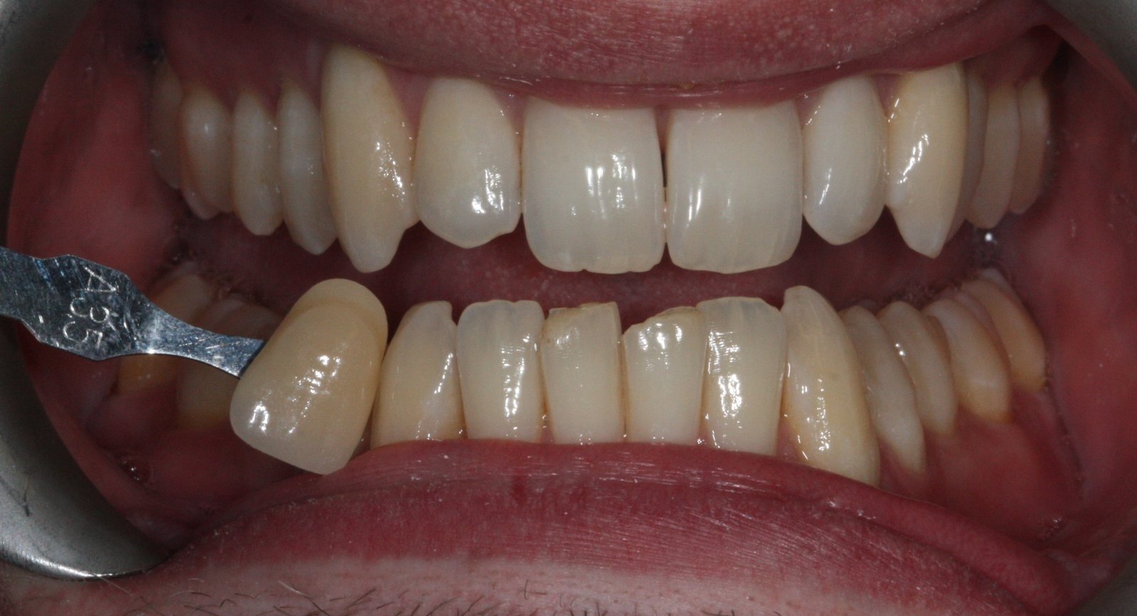 1 Teeth whitening Before 1 Teeth whitening Before